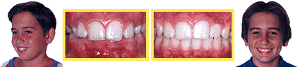 Before and After Non-Extraction Orthodontics Treatment