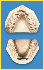 Mouth Breathing - Arch Development with flawed tongue function